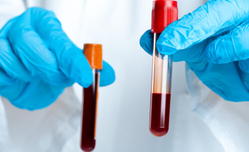 Blood samples